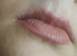 Steaming your face helps to open up the blocked pores to allow the accumulated material to come out. Skin Concerns What Are These Small Bumps On My Lip Line And How Can I Get Rid Of Them Skincareaddiction