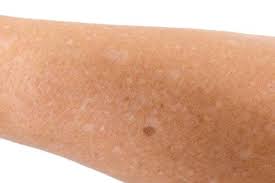 White Spots On Skin From Sun Causes Treatment And How To Prevent Tiege Hanley