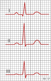 Cv Physiology Electrocardiogram Standard Limb Leads Bipolar