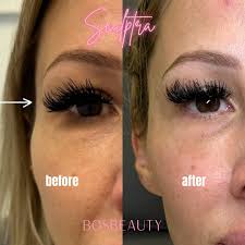 What is Sculptra? 👇🏻 As we age, our skin visibly shows signs of aging  like a lack of volume, fine lines and wrinkles. With Sculptra you are going  to see that lost