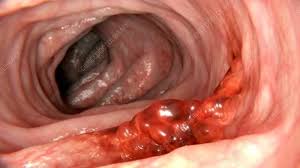 Colón, taccone, and webb are hoping to change that. Colon Cancer Animation Stock Video Clip K006 9850 Science Photo Library