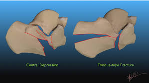 Image result for Fracture Types