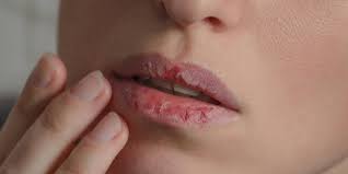 Labios Ressecados O Que Fazer Para Tratar Ressecamento Labial Donna