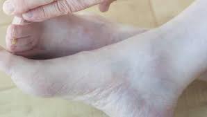 • chronic bronchitis involves the large and small airways getting swollen and full of mucus. Gangrene And Diabetes Understanding The Link