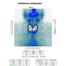 Es gibt eine untersuchung, deren ergebnis in der regel bei allen hyperthyreoseformen in gleicher weise ausfällt. Schilddrusenszintigraphie Radiologie Und Nuklearmedizin Ludwigshafen