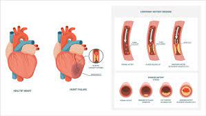 Coronary Heart Disease Diagnosis And Treatment In Thailand Almurshidi Medical Tourism Agency Hospitals In Thailand