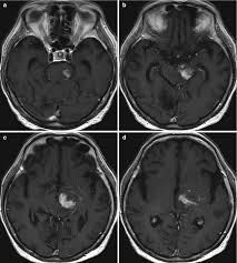 Although the perivascular lesion localization is a pathologic hallmark of clippers, an intralesional vessel could not be depicted in vivo by using conventional mri at lower magnetic field strength. Clippers Infiltrative Brainstem Lymphoma Springerlink