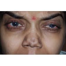 Pritesh Sheth, Author at Indian Journal of Dermatology, Venereology and  Leprology