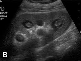 Renal Papillary Necrosis Ultrasound Google Search Ultrasound Ultrasound Ultrasound Technician Ultrasound Sonography