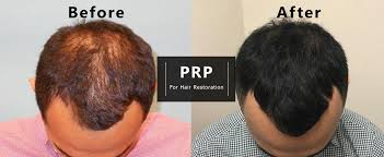 Vampire hair regrowth is a procedure first developed and trademarked by dr. Prp For Hair Restoration Warrenton Hair Growth Prp Prevent Hair Loss