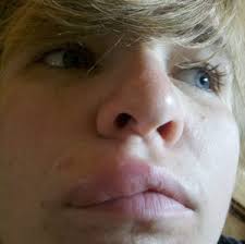 Image result for Angioedema