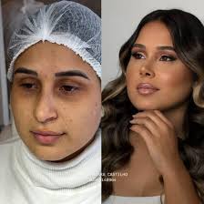 Eu AMO receber fotos dos pacientes com o narizinho novo 👃🏼🥹🫶🏼 Olhem  essas fotos que recebi ➡️ auto estima lá no alto com um nariz desse!!  😮‍💨🤌🏼 ❗️Lembrando que: cada nariz tem