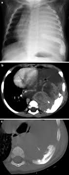 Pectus excavatum is a congenital, concave deformity of the caudal sternum that results in a reduced ventrodorsal thoracic diameter.1,2 the cause is unknown, although a hereditary component has been suggested.3 pectus excavatum can result in compromised pulmonary and cardiac function due to. Radiology Of The Chest Wall Springerlink