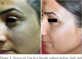 Pdf Treatment Of Nevus Of Ota With 1064 Nm Q Switched Nd Yag Semantic Scholar