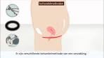 Verzakking - Oorzaak en behandeling - YouTube