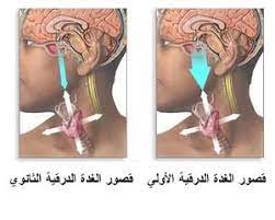 قصور الغدة الدرقية المعرفة