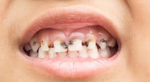 Purging is actually leading me to the next binge, purging is one of the biggest reason why i am binging in the first place. Bulimia Teeth Damage What You Need To Know How To Stop It