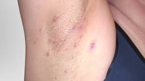 Hs Symptoms Pictures No Bs About Hs