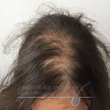 Haarausfall Wechseljahren Ursachen Therapie Hintergrunde