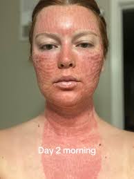 Laser Resurfacing After Care