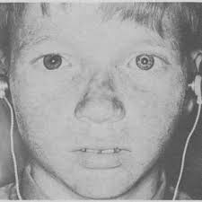 PDF) Development and Significance of Heterochromia of the Iris