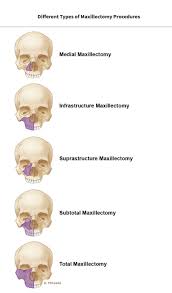 A canker sore looks like an ulcer, usually. Cancer Tumors Head And Neck Surgery Of North Texas Pllc
