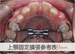 上顎固定式擴張器進度參考表11mm – 兒童牙科黃渝聖醫師