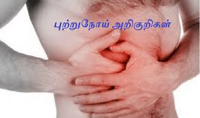 Persons who have tongue cancer will report to manifest and experience the following symptoms and signs à®ª à®± à®± à®¨ à®¯ à®…à®± à®• à®± à®•à®³ Cyber Tamizha