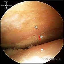 Patellofemoral Arthritis M17 10 715 16 Eorif