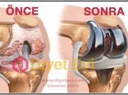 Eklem Diz Agrilarini Geciren Dogal Tedavi Yontemi 376x280 1 Dogal Tedaviler Bitkisel Ilac Kolay Egzersiz