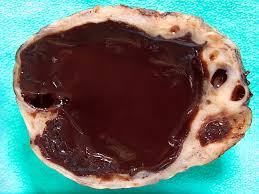 These cysts may invade the renal capsule, or the fibrous layer surrounding the kidneys, and cause pain. Webpathology Com A Collection Of Surgical Pathology Images