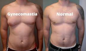 You may find the male breast reduction for gynaecomastia article more useful, or one of our other health articles. 7 Things To Know About Gynecomastia Tops Health Info