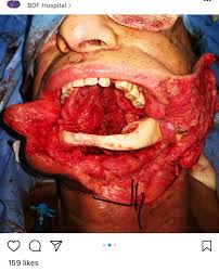 The scariest part is, that of the recent deaths, all of them were within 10 days to 6 weeks of diagnosis. Oral Cancer Removal Medicalgore