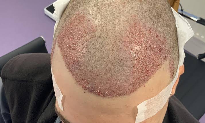 What Are The Potential Side Effects Of A Hair Transplant