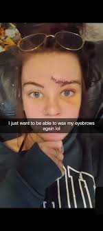 Headbutting a bed and getting a scar