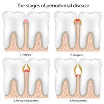 This involves regular brushing with fluoride toothpaste, flossing, and having frequent dental checkups. Dentist In Ridgefield Explains Why Healthy Gums Healthy Brain Function