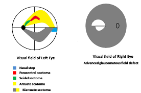 Image result for Visual Field Deficit