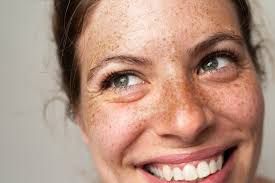 Image result for Freckles
