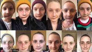 ناجية توثق رحلة شفائها من السرطان صور قبل وبعد بناء الوجه