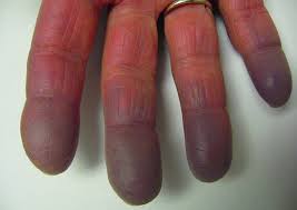 Mehr über symptome, ursachen und therapie von wundrose. Systemischer Lupus Erythematodes Sle Knochen Gelenk Und Muskelerkrankungen Msd Manual Ausgabe Fur Patienten