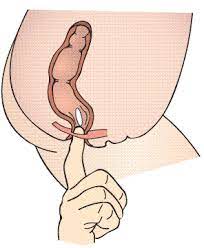 How do glycerin suppositories work? Glycerin Glycerol Suppositories For Constipation Medicines For Children