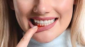 • inflammation exists until is eliminated the etiological factor and are inactivated inflammatory. Gum Swelling Treatment By Home Remedies And Professional Care Dentist In San Rafael Ca