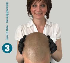 Tricopigmentazione per la caduta dei capelli: Tricopigmentazione Micropigmentazione Capelli Tricodermsolutions