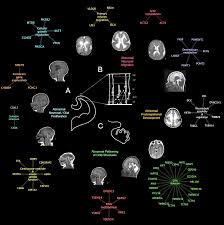 Physiopathologie moléculaire et cellulaire des anomalies du développement du  cortex cérébral Le syndrome d'Aicardi