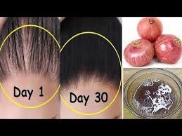 Lecithin helps restore damaged hair caused by frequent dye procedures. How To Grow Long Stop Hair Fall With Onion Egg Magical Hair Growth Treatment 100 Works Hair Growth Treatment Extreme Hair Growth How To Grow Natural Hair