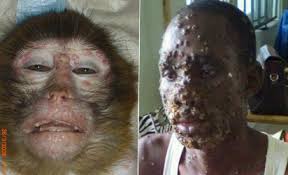 Monkeypox is an infectious disease caused by the monkeypox virus that can occur in certain animals including humans. Ncdc Investigates Uk Monkeypox Outbreak Vanguard News