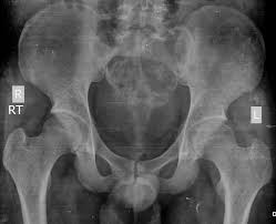 Leichlingen mit 2.557 einwohnern sowie bürrig mit 338 einwohnern kamen zu opladen, wo nur rund 400 einwohner lebten. Salvage Treatment Of Aggressive Giant Cell Tumor Of Bones With Denosumab Abstract Europe Pmc