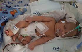 Baby With Water On The Brain Fights To Stay Alive Health24