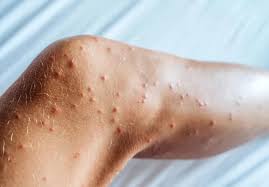 Image result for bedbug bites look like