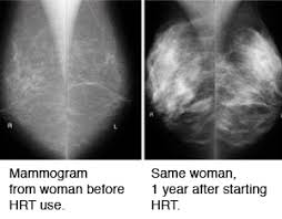 The american study analysed data from more than 60,000 women and found that over 3. Do Changes In Breast Density Over Time Influence Breast Cancer Risk Mayo Mammography Health Study Mayo Clinic Research